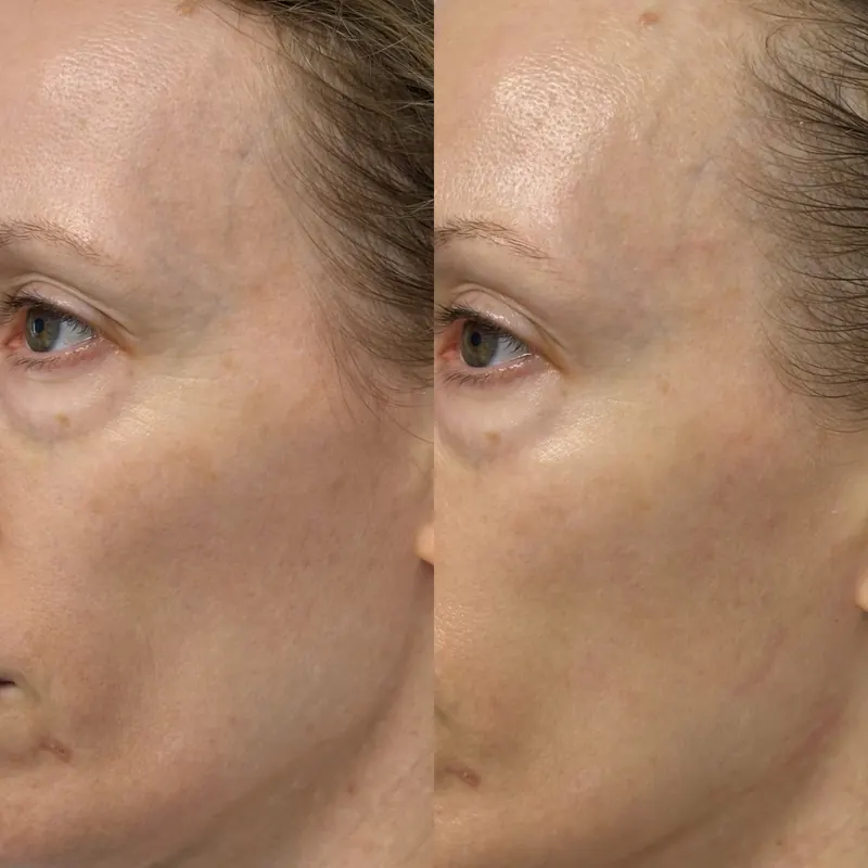Detaliu al feței unei cliente, două imagini alăturate din programul de remodelare facială la MÉDA SKIN Solutions