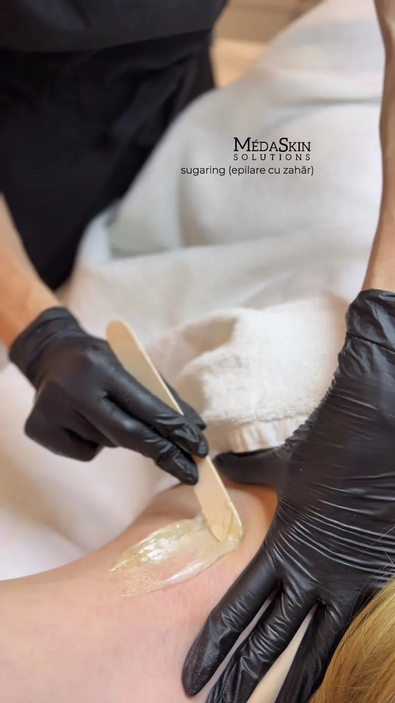 Epilare cu pastă de zahăr realizată cu spatula la MÉDA SKIN Solutions